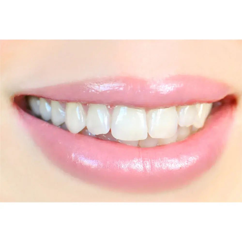 Before-and-After-Veneers-2-3