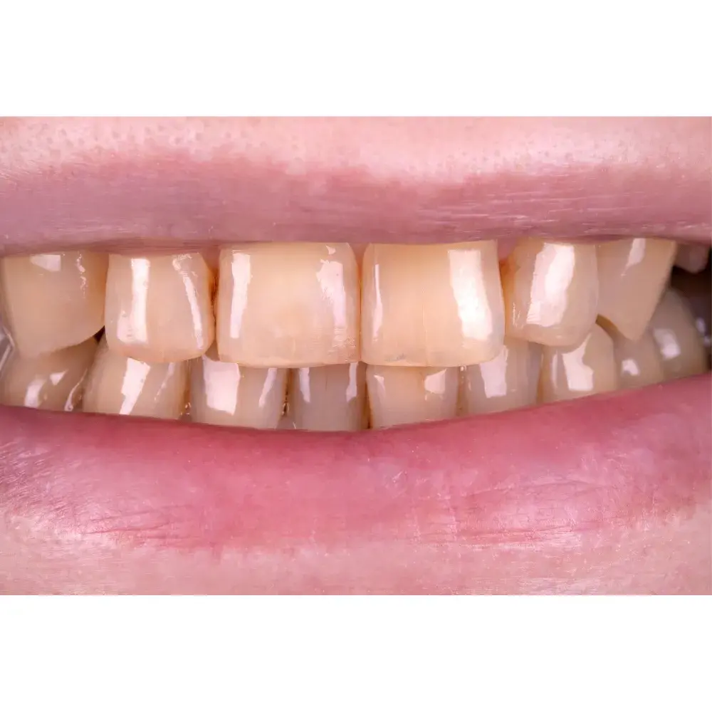 Before-and-After-Veneers-2-5
