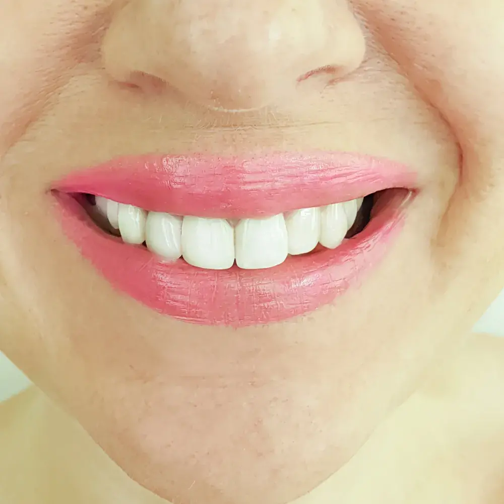 Before-and-After-Veneers-2