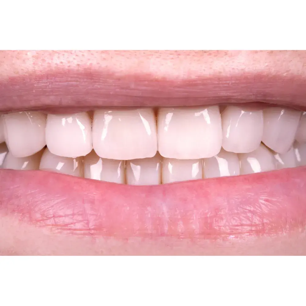 Before-and-After-Veneers-6