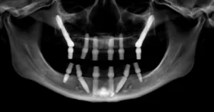 All on X Dental Implants