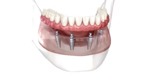 All on x Dental Implants