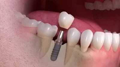 implant dentist