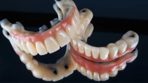 All on X Dental Implants