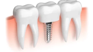 Dental Implants