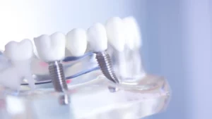 Implant Dentist