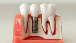 Dental Implants