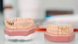 Dental Implants