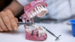 Dental Implants