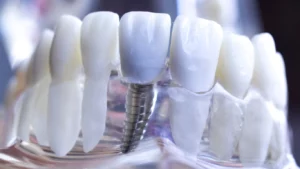 Implant Dentist
