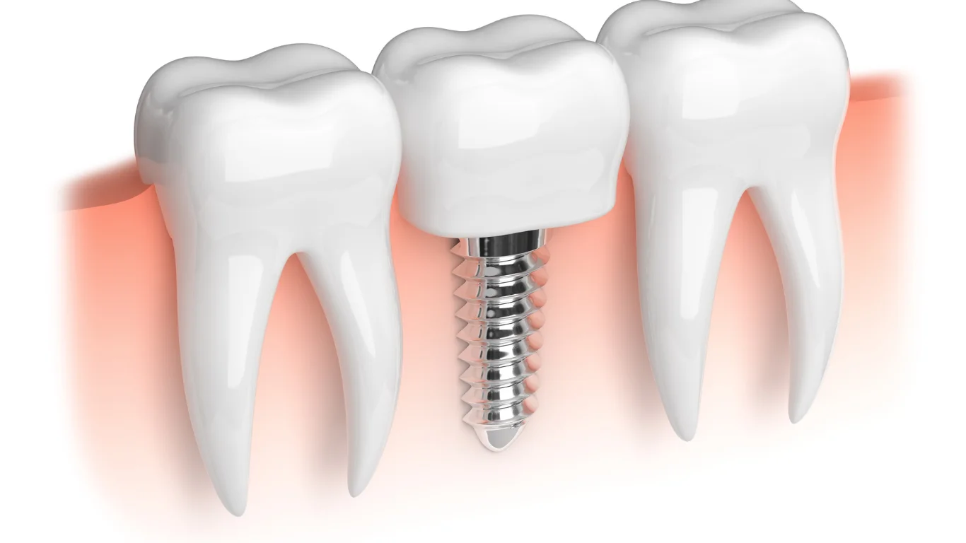 Dental Implants
