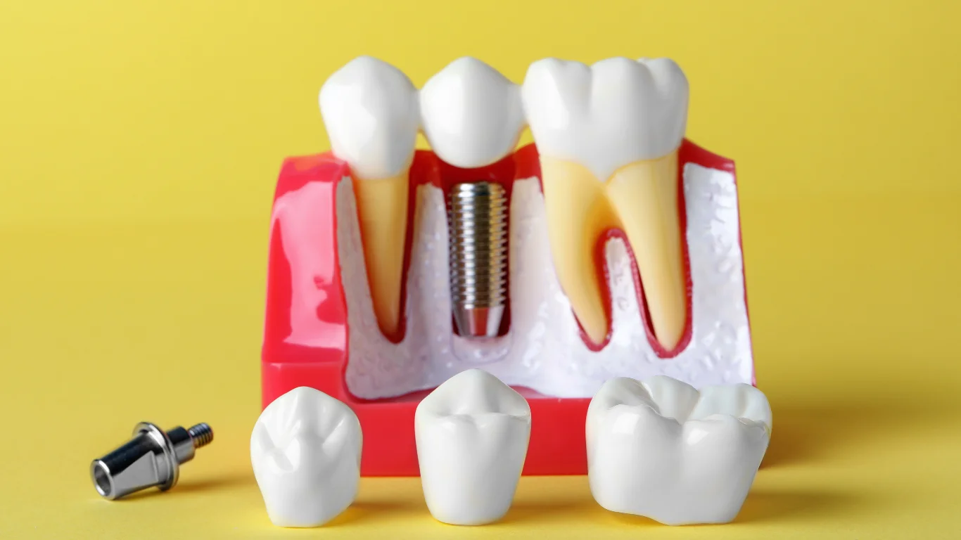 Dental Implants