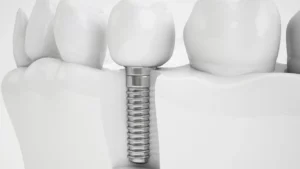 Dental Implants