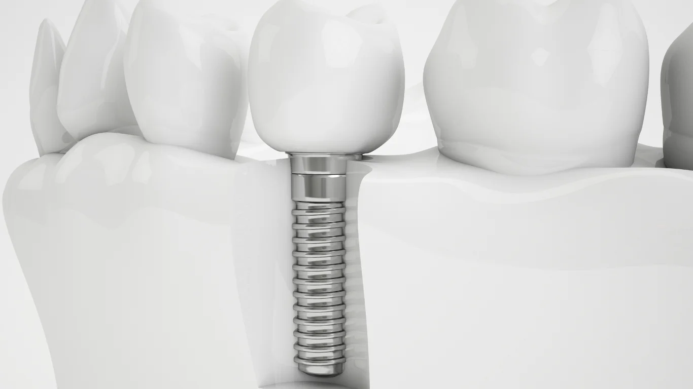 Dental Implants