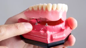All on 4 Dental Implants